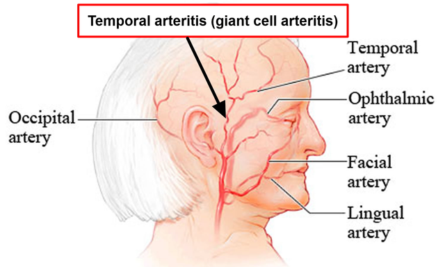 Baricitinib and its potential role in treating Giant Cell Arteritis