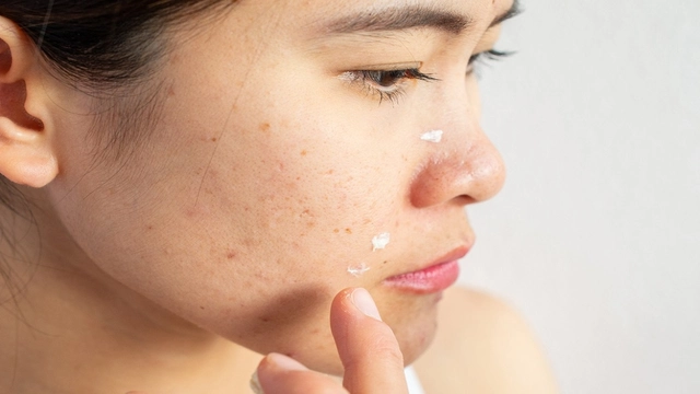 Acne and Skin Care: Common Ingredients to Avoid