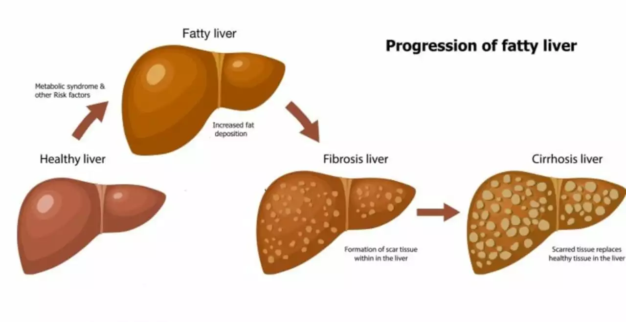Abacavir and liver health: What you need to know